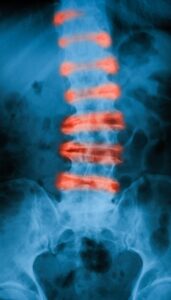 X-ray showing damaged area of lower spine in red.