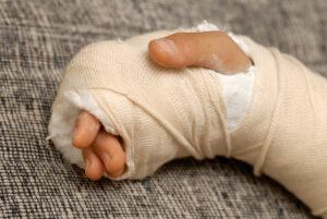 A hand wrapped in plaster and bandages 
